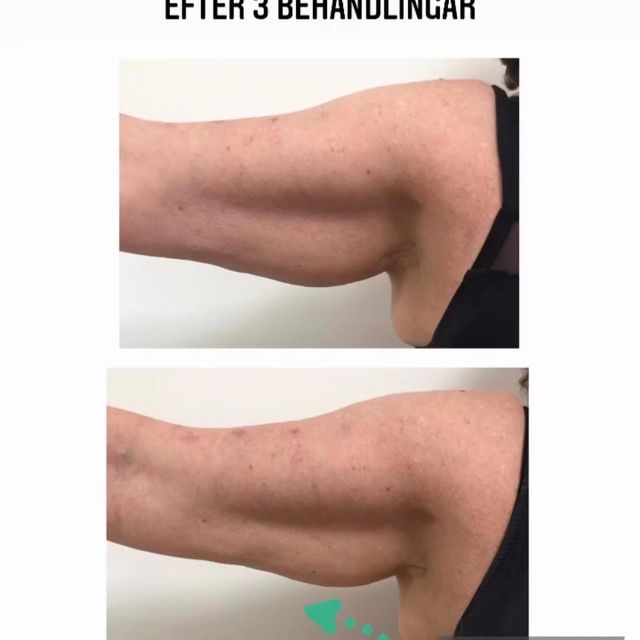 armbild före och efter