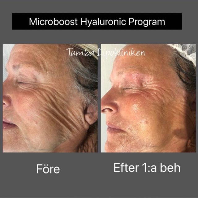 microboost före och efter